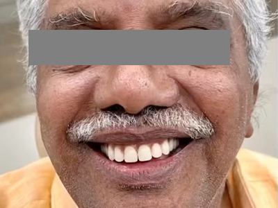 Smile Makeover - After