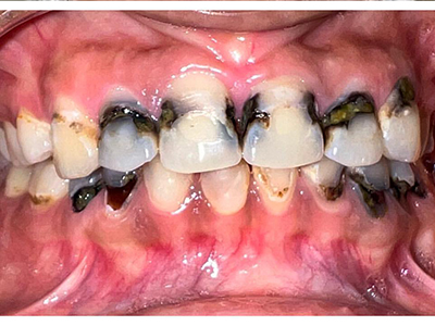 Smile Designing - Before