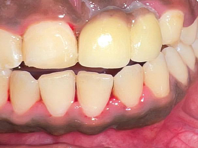 Dental Implants - After
